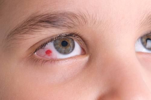 a child with an Eye Allergy