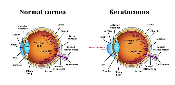 How Is Keratoconus Treated?
