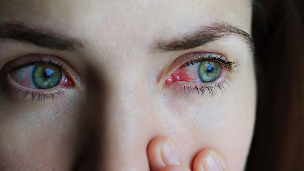 a woman with Uveitis